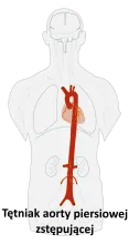 Tętniak aorty piersiowej zstępującej 