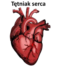 Tętniak serca 