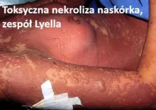Toksyczna nekroliza naskórka