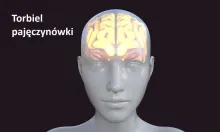 Torbiel pajęczynówki 
