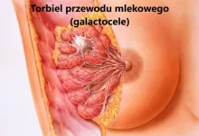 Torbiel przewodu mlekowego galactocele 