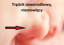 Trądzik noworodkowy
