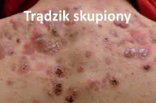 Trądzik skupiony 