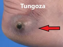 Tungoza, tungiaza, sarkopsyloza 
