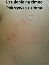 Uczulenie na zimno, pokrzywka z zimna