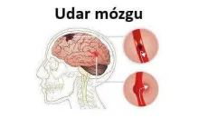 udar mózgu