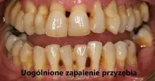 Uogólnione zapalenie przyzębia, generalized periodontitis