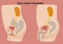 Uraz cewki moczowej