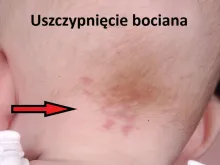 Uszczypnięcie bociana 