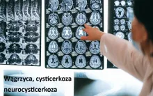 CYSTICERKOZA, NEUROCYSTICERKOZA, wągrzyca ośrodkowego układu nerwowego objawy leczenie