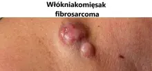 Włókniakomięsak, fibrosarcoma
