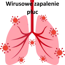 WIRUSOWE ZAPALENIE PŁUC, wirusowe zapalenie płuc rsv objawy u dziecka dorosłego leczenie 