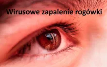 WIRUSOWE ZAPALENIE ROGÓWKI, OPRYSZCZKOWE ZAPALENIE ROGÓWKI, opryszczka rogówki