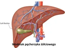 Wodniak pęcherzyka żółciowego, torbiel, rozciągnięty pęcherzyk żółciowy 