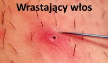 Wrastający włos, wrośnięty włos