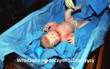 WRODZONA NIEDOCZYNNOŚĆ TARCZYCY U NOWORODKA, wrodzona niedoczynność tarczycy