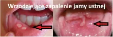 Wrzodziejące zapalenie jamy ustnej