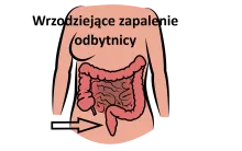 Wrzodziejące zapalenie odbytnicy