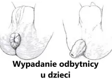 Wypadanie odbytnicy u dzieci