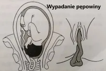 Wypadanie pępowiny