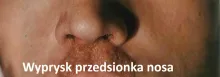 Wyprysk przedsionka nosa