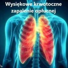 Wysiękowe krwotoczne zapalenie opłucnej