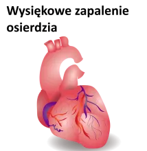 Wysiękowe zapalenie osierdzia