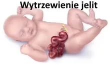 Wytrzewienie jelit 