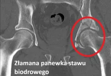 Złamana panewka stawu biodrowego