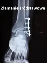 Złamanie śródstawowe, złamania śródstawowe 