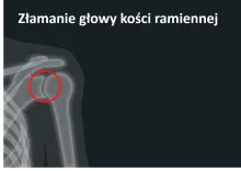 Złamanie głowy kości ramiennej, uraz głowy kości ramiennej 
