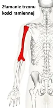Złamanie trzonu kości ramiennej