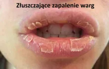 Złuszczające zapalenie warg 