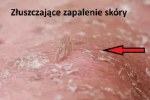 Złuszczające zapalenie skóry 