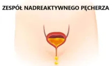 zespół nadreaktywnego pęcherza 