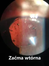 Zaćma wtórna objawy leczenie