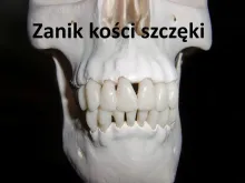 Zanik kości szczęki 