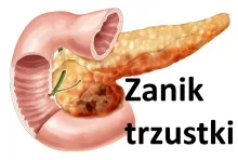 ZANIK TRZUSTKI, ATROFIA TRZUSTKI, TRZUSTKA ZANIKOWA 