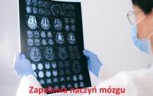 Zapalenia naczyń mózgu