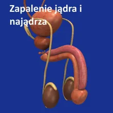 Zapalenie jądra i najądrza 