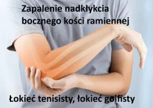 łokieć tenisisty, łokieć golfisty 