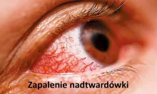 Zapalenie nadtwardówki 