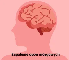 Zapalenie opon mózgowych