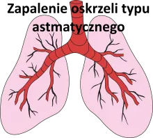 Zapalenie oskrzeli typu astmatycznego