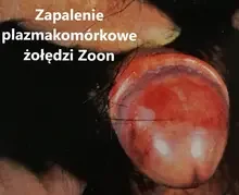 Zapalenie plazmakomórkowe żołędzi Zoon