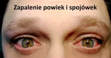 Zapalenie powiek i spojówek