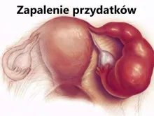 Zapalenie przydatków 