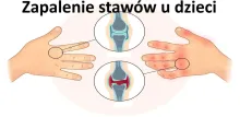 Zapalenie stawów u dzieci 