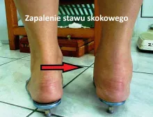 Zapalenie stawu skokowego 