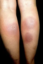 Zapalenie tkanki podskórnej 